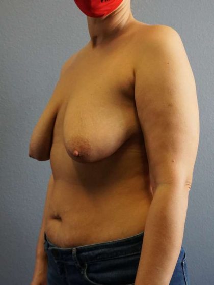Breast Lift with Implant (Augmentation Mastopexy) Before & After Patient #4162