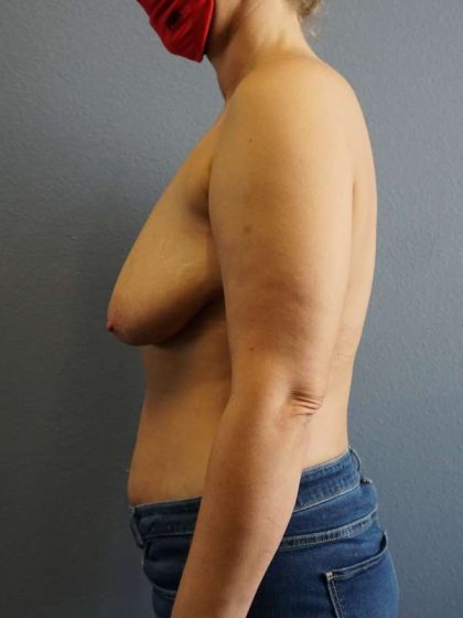 Breast Lift with Implant (Augmentation Mastopexy) Before & After Patient #4162