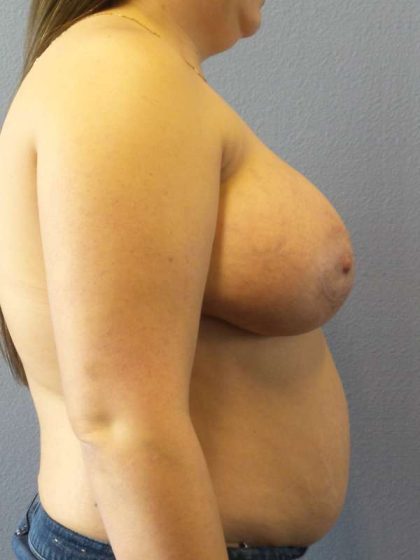 High BMI (Larger Patients) Surgery Before & After Patient #6137