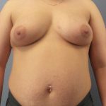 High BMI (Larger Patients) Surgery Before & After Patient #6137