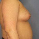 High BMI (Larger Patients) Surgery Before & After Patient #6137