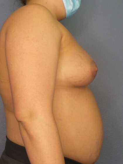 High BMI (Larger Patients) Surgery Before & After Patient #6137