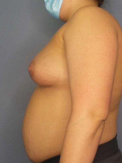High BMI (Larger Patients) Surgery Before & After Patient #6137