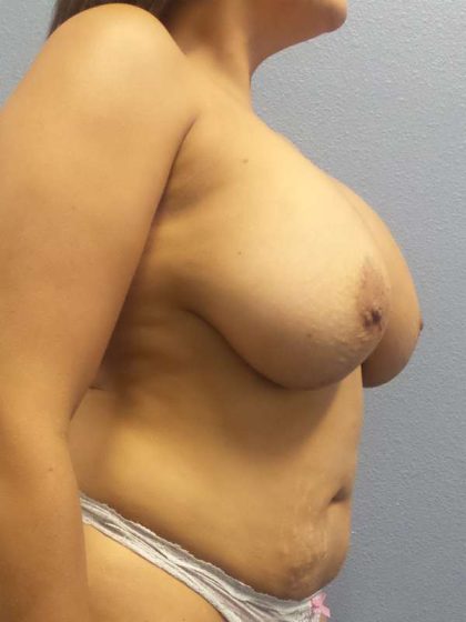 Mastopexy (Breast Lift) Before & After Patient #8414
