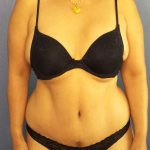 Abdominoplasty Before & After Patient #3504