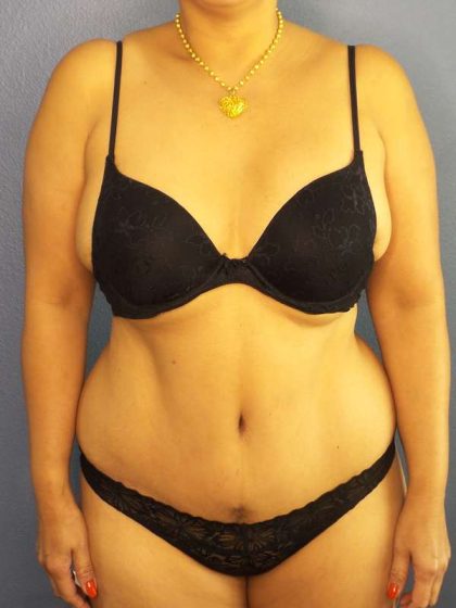 Abdominoplasty Before & After Patient #3504