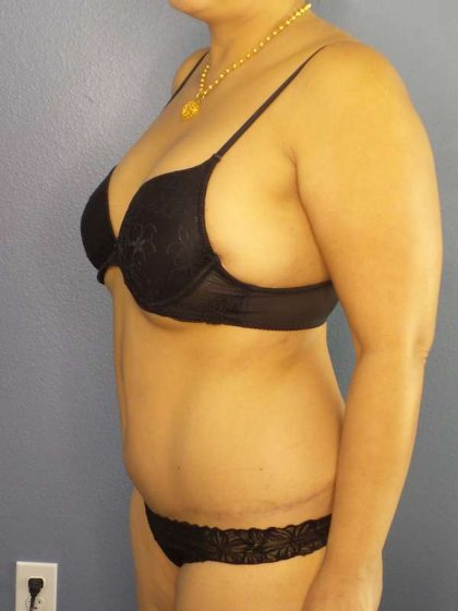 Abdominoplasty Before & After Patient #3504