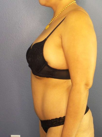 Abdominoplasty Before & After Patient #3504
