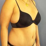 Abdominoplasty Before & After Patient #3504