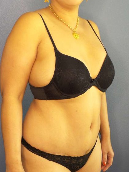 Abdominoplasty Before & After Patient #3504