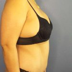 Abdominoplasty Before & After Patient #3504