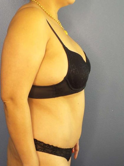 Abdominoplasty Before & After Patient #3504