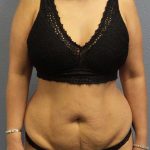 Abdominoplasty Before & After Patient #3504