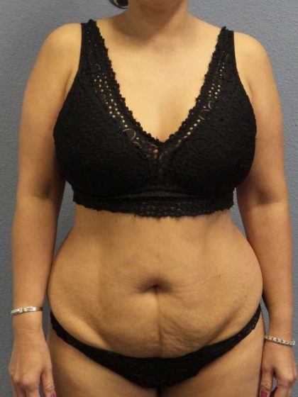 Abdominoplasty Before & After Patient #3504