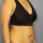 Abdominoplasty Before & After Patient #3504
