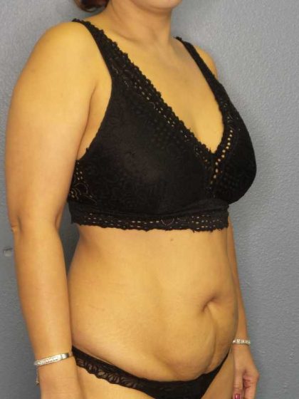 Abdominoplasty Before & After Patient #3504