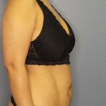 Abdominoplasty Before & After Patient #3504