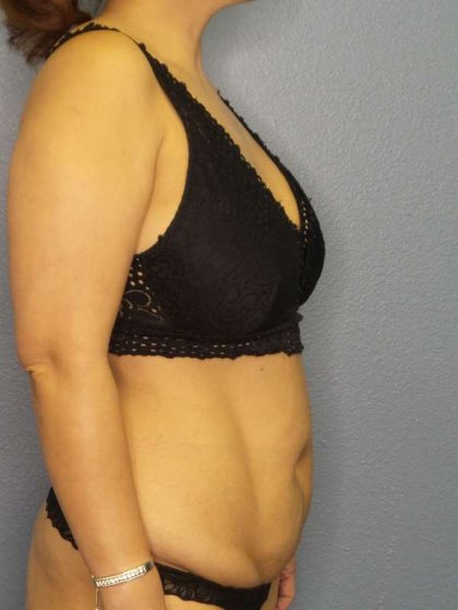 Abdominoplasty Before & After Patient #3504