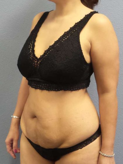 Abdominoplasty Before & After Patient #3504