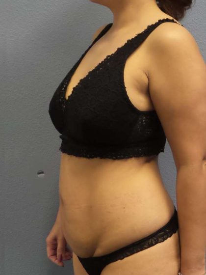 Abdominoplasty Before & After Patient #3504