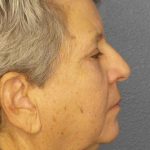 Periorbital Before & After Patient #8570