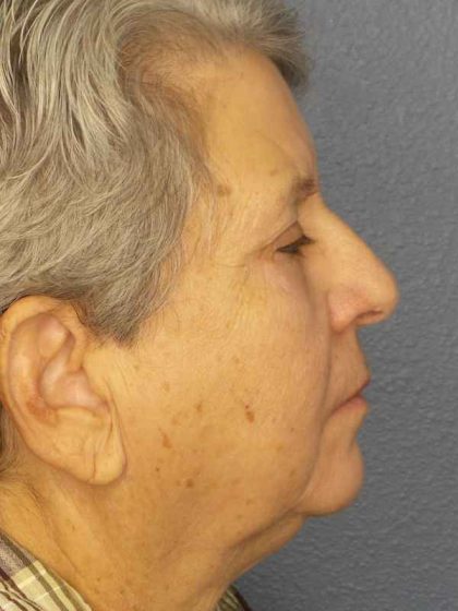 Periorbital Before & After Patient #8570