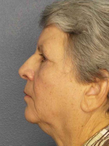 Periorbital Before & After Patient #8570
