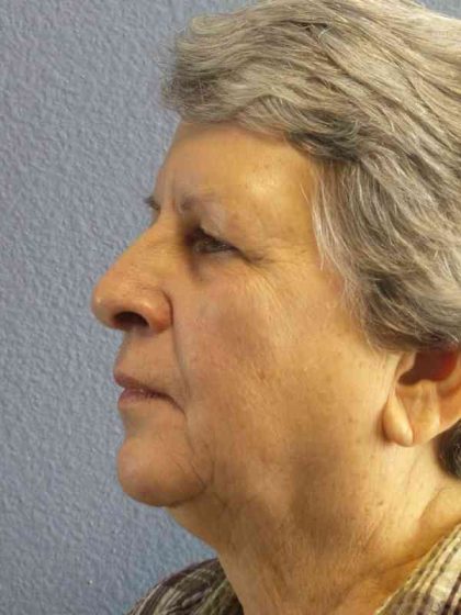 Periorbital Before & After Patient #8570