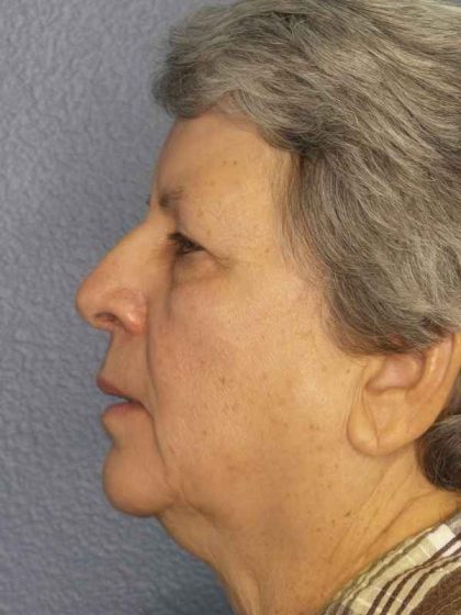 Periorbital Before & After Patient #8570