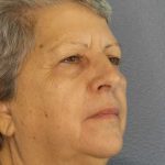 Periorbital Before & After Patient #8570