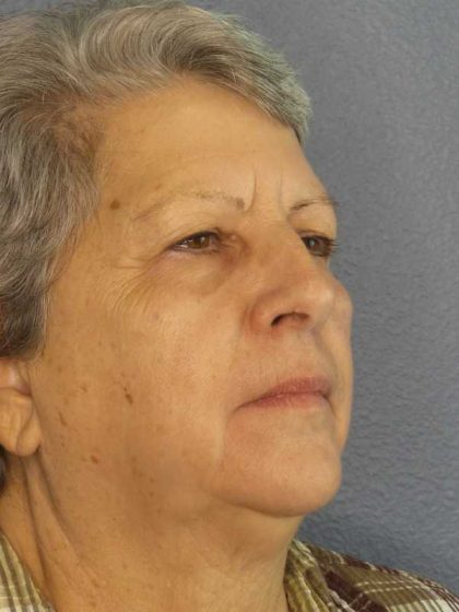 Periorbital Before & After Patient #8570