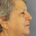 Periorbital Before & After Patient #8570