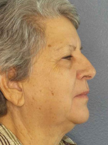 Periorbital Before & After Patient #8570