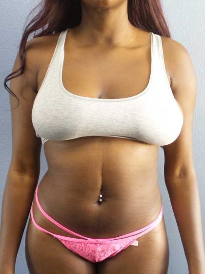 Liposuction Female Before & After Patient #7907
