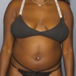Liposuction Female Before & After Patient #7907