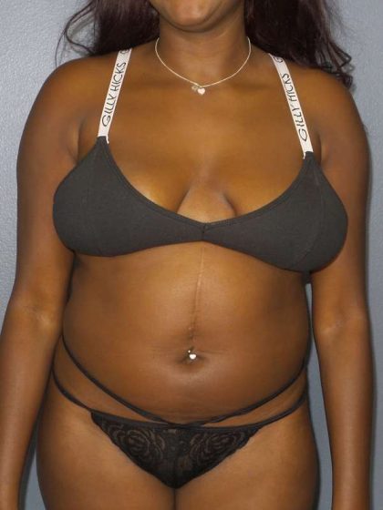 Liposuction Female Before & After Patient #7907