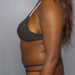 Liposuction Female Before & After Patient #7907