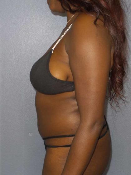 Liposuction Female Before & After Patient #7907