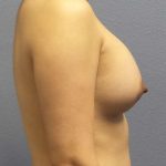 Breast Augmentation Before & After Patient #5170
