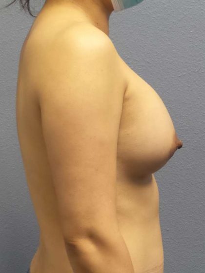 Breast Augmentation Before & After Patient #5170