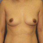 Breast Augmentation Before & After Patient #5170