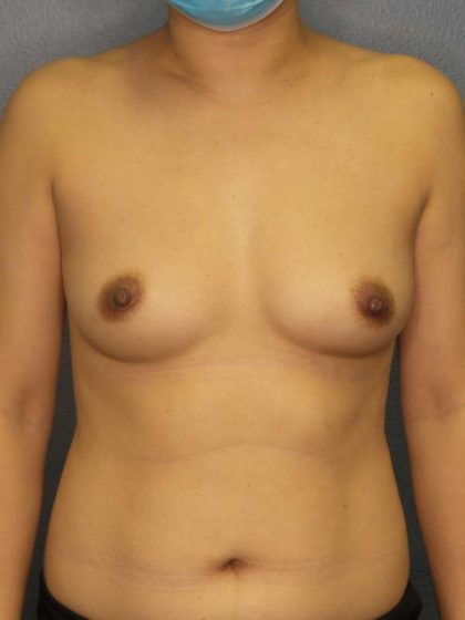 Breast Augmentation Before & After Patient #5170