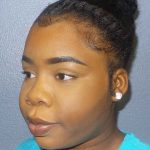 Filler Before & After Patient #7624