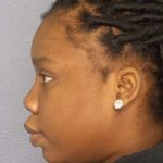 Filler Before & After Patient #7624
