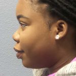 Filler Before & After Patient #7624