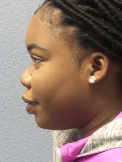 Filler Before & After Patient #7624