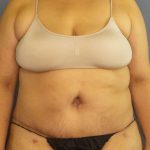 High BMI (Larger Patients) Surgery Before & After Patient #10340