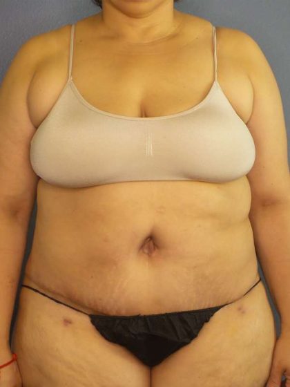 High BMI (Larger Patients) Surgery Before & After Patient #10340