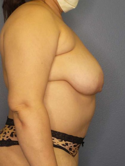 High BMI (Larger Patients) Surgery Before & After Patient #10340