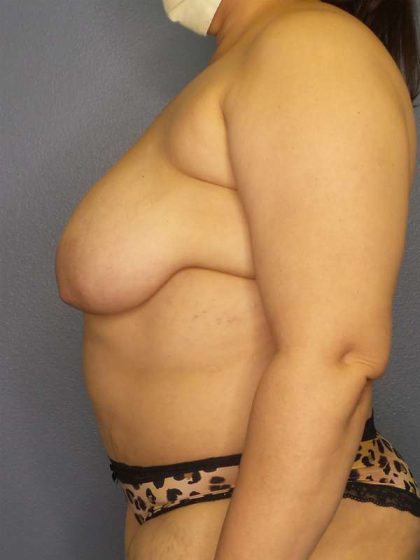 High BMI (Larger Patients) Surgery Before & After Patient #10340